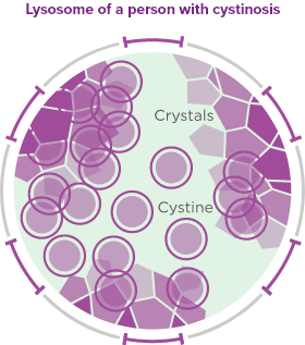 Illustration of lysosome of a person with cystinosis, showing how cystine builds up because it is unable exit the lysosome